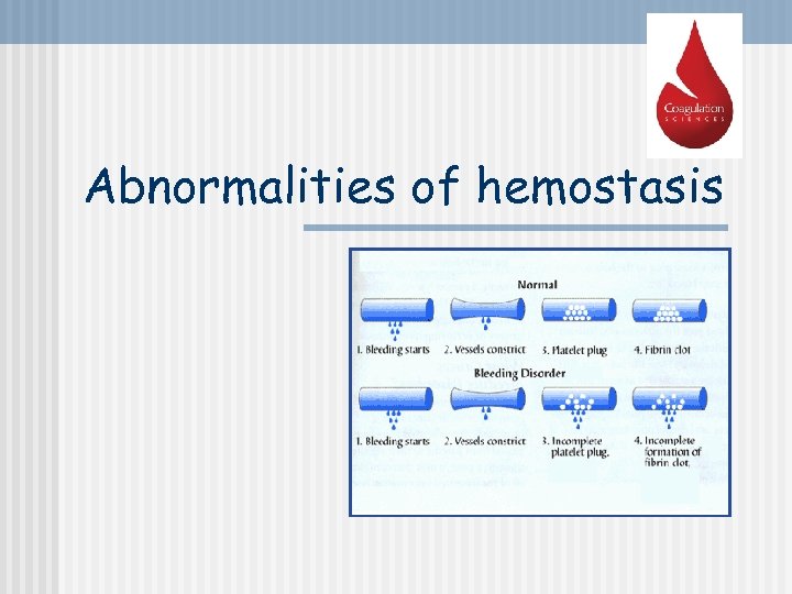 Abnormalities of hemostasis 