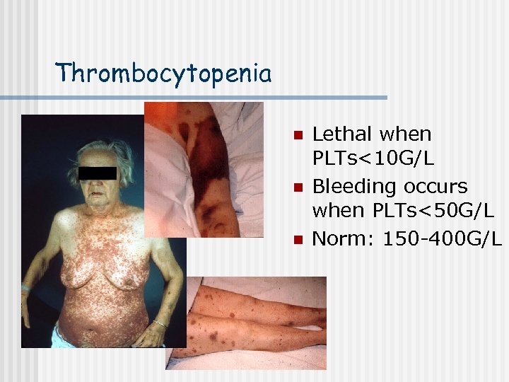 Thrombocytopenia n n n Lethal when PLTs<10 G/L Bleeding occurs when PLTs<50 G/L Norm: