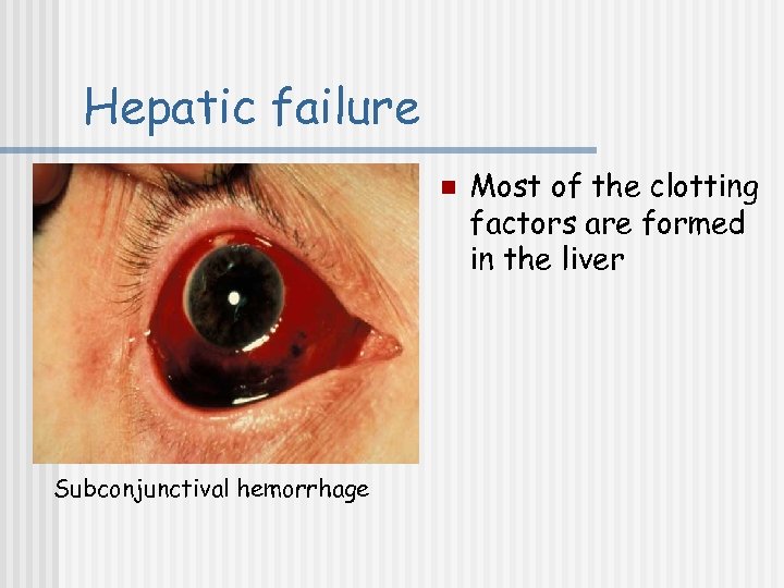 Hepatic failure n Subconjunctival hemorrhage Most of the clotting factors are formed in the