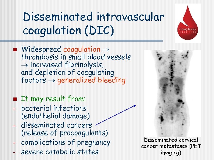 Disseminated intravascular coagulation (DIC) n n - Widespread coagulation thrombosis in small blood vessels