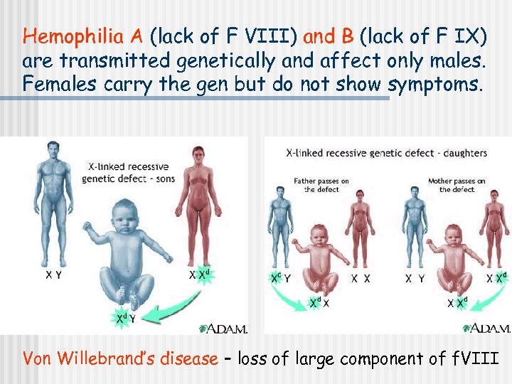 Hemophilia A (lack of F VIII) and B (lack of F IX) are transmitted