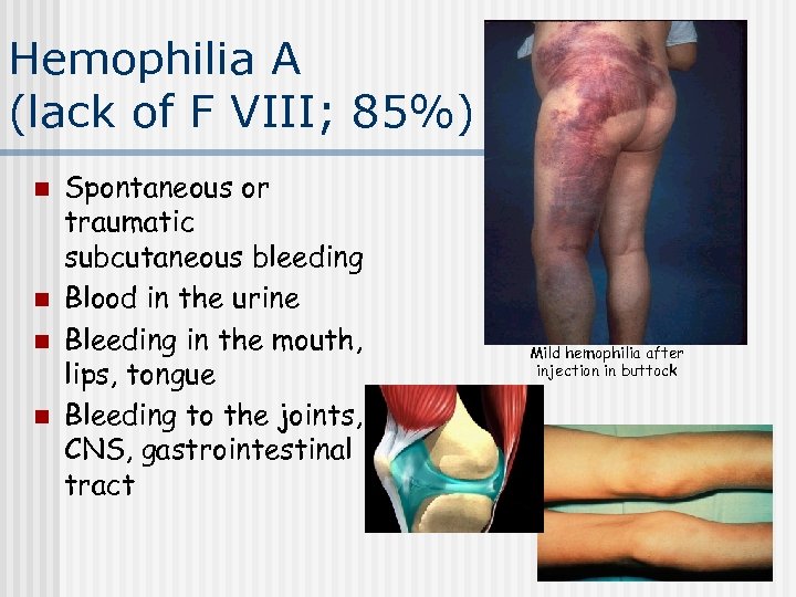 Hemophilia A (lack of F VIII; 85%) n n Spontaneous or traumatic subcutaneous bleeding