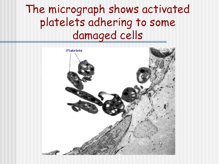 The micrograph shows activated platelets adhering to some damaged cells 