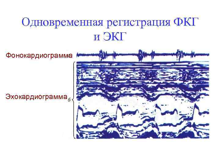 Одновременная регистрация ФКГ и ЭКГ Фонокардиограмма Эхокардиограмма 