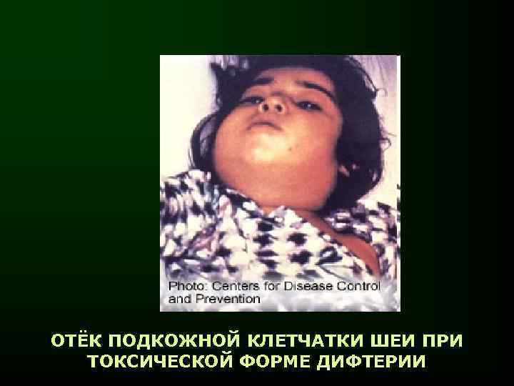 ОТЁК ПОДКОЖНОЙ КЛЕТЧАТКИ ШЕИ ПРИ ТОКСИЧЕСКОЙ ФОРМЕ ДИФТЕРИИ 