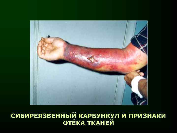 СИБИРЕЯЗВЕННЫЙ КАРБУНКУЛ И ПРИЗНАКИ ОТЁКА ТКАНЕЙ 
