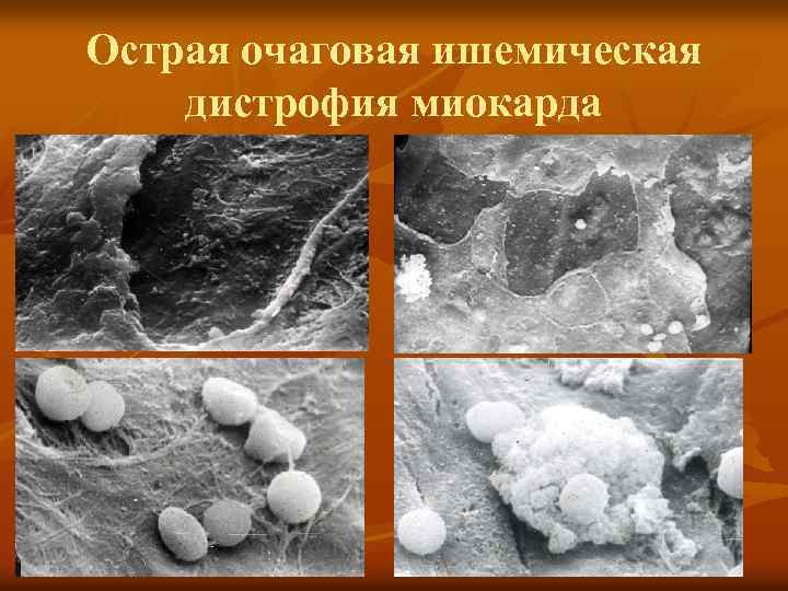 Острая очаговая ишемическая дистрофия миокарда 