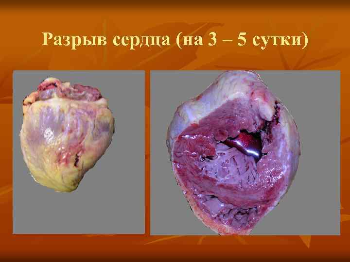 Разрыв сердца (на 3 – 5 сутки) 