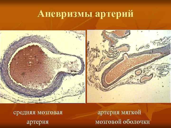 Аневризмы артерий средняя мозговая артерия мягкой мозговой оболочки 