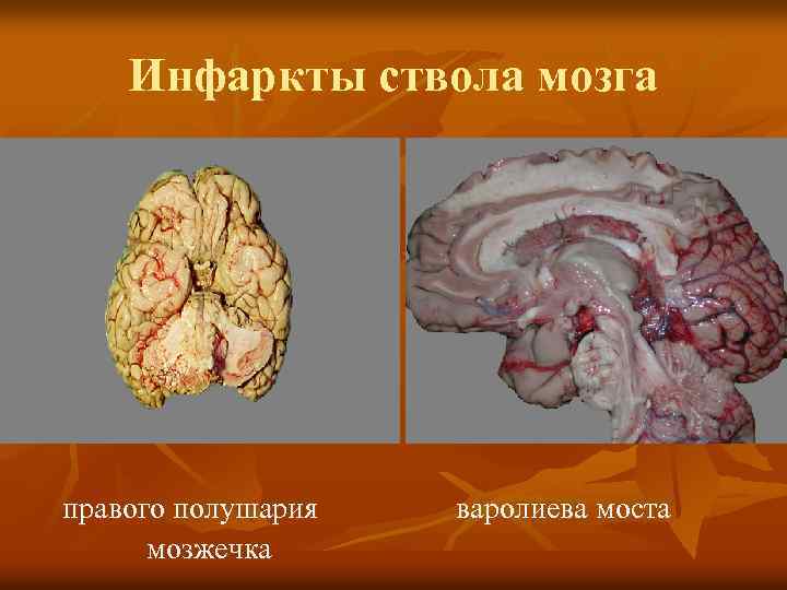 Инфаркты ствола мозга правого полушария мозжечка варолиева моста 