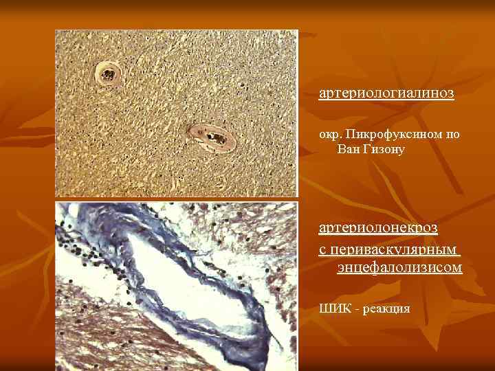 артериологиалиноз окр. Пикрофуксином по Ван Гизону артериолонекроз с периваскулярным энцефалолизисом ШИК - реакция 