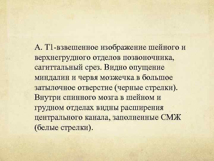 А. Т 1 -взвешенное изображение шейного и верхнегрудного отделов позвоночника, сагиттальный срез. Видно опущение