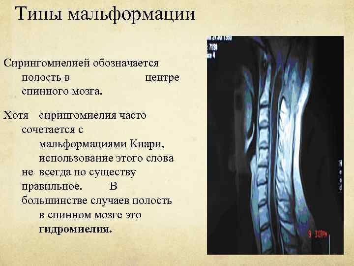 Типы мальформации Сирингомиелией обозначается полость в центре спинного мозга. Хотя сирингомиелия часто сочетается с