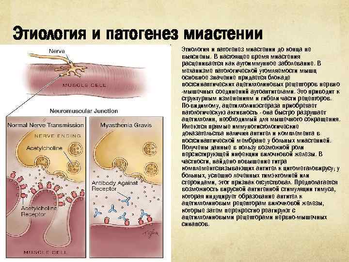 Этиология и патогенез миастении до конца не выяснены. В настоя щее время миастения расценивается