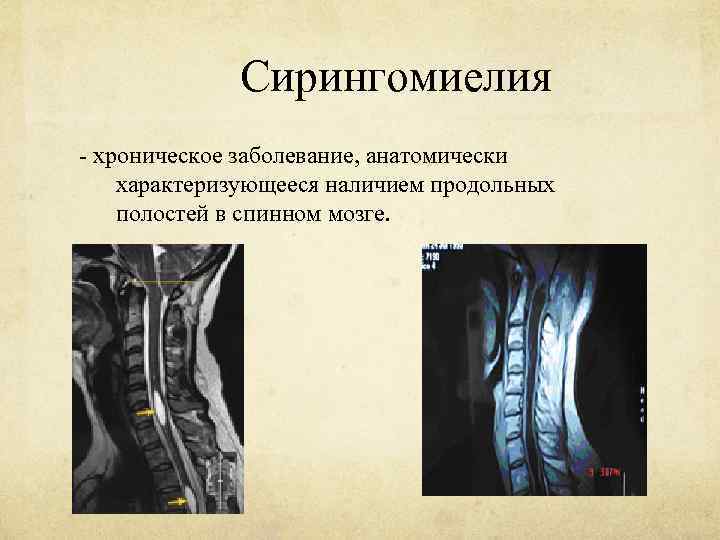 Сирингомиелия - хроническое заболевание, анатомически характеризующееся наличием продольных полостей в спинном мозге. 