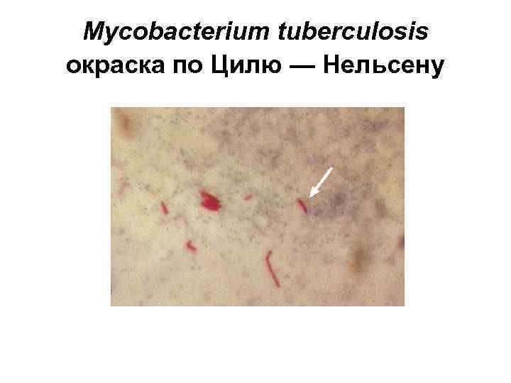 Mycobacterium tuberculosis окраска по Цилю — Нельсену 