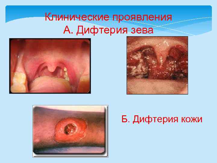 Клинические проявления А. Дифтерия зева Б. Дифтерия кожи 