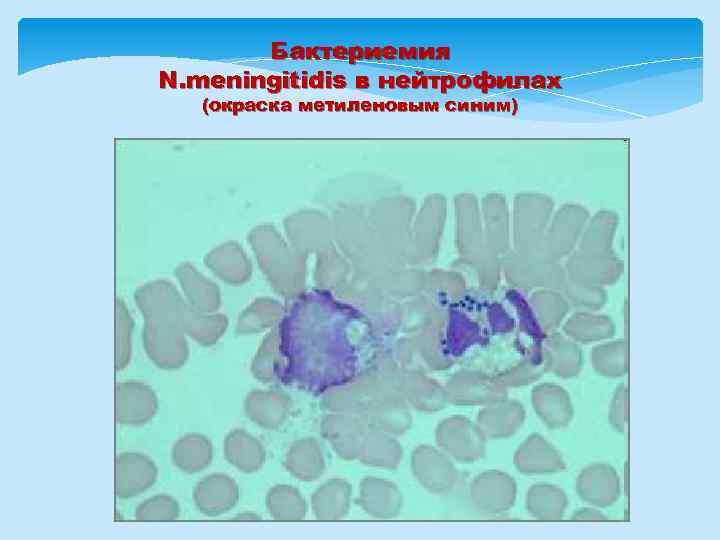 Бактериемия N. meningitidis в нейтрофилах (окраска метиленовым синим) 