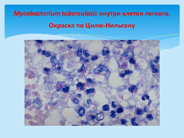 Mycobacterium tuberculosis внутри клеток легкого. Окраска по Цилю-Нильсену 