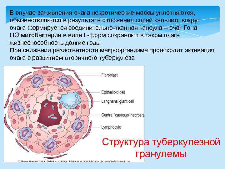 В случае заживления очага некротические массы уплотняются, обызвествляются в результате отложения солей кальция, вокруг