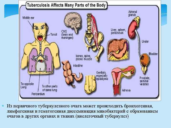 Патогенез (продолжение) Из первичного туберкулезного очага может происходить бронхогенная, лимфогенная и гематогенная диссеминация микобактерий