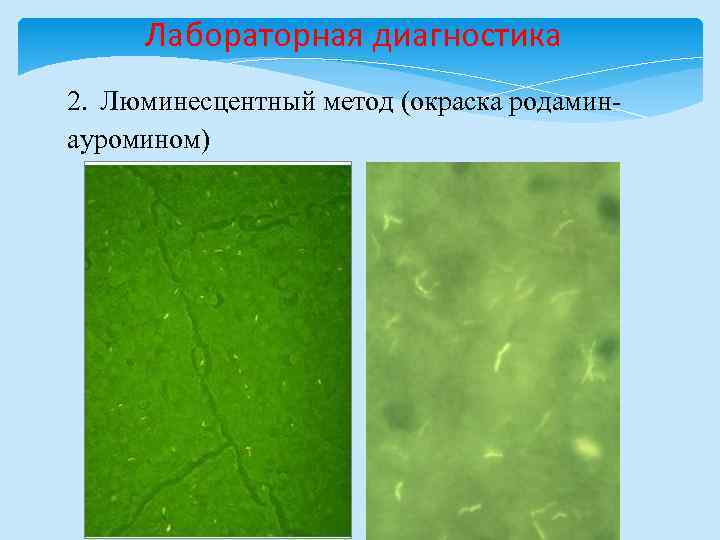 Лабораторная диагностика 2. Люминесцентный метод (окраска родаминауромином) 