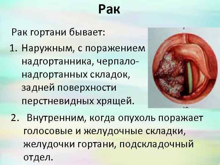 Рак гортани бывает: 1. Наружным, с поражением надгортанника, черпaлонадгортанных складок, задней поверхности перстневидных хрящей.