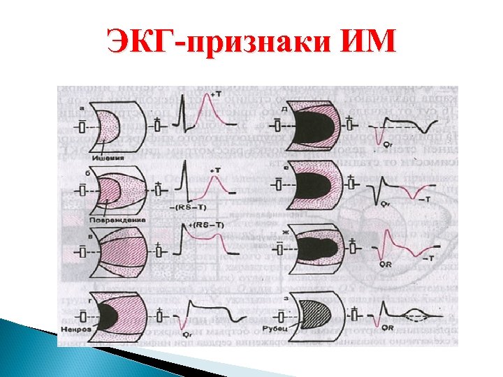 Экг признаки окс