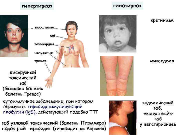 гипертиреоз гипотиреоз кретинизм экзофтальм зоб тахикардия исхудание тремор микседема диффузный токсический зоб (базедова болезнь