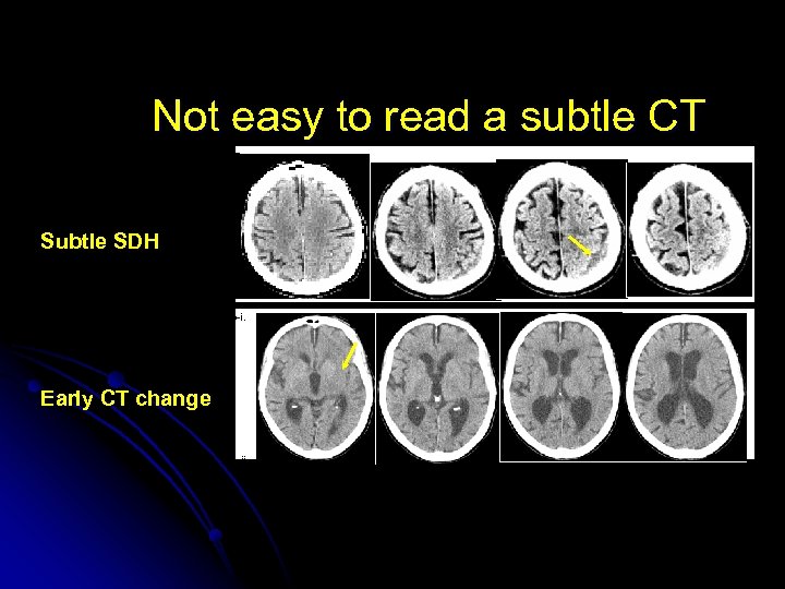 Not easy to read a subtle CT a. Subtle SDH b-i. Early CT change