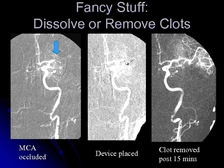 Fancy Stuff: Dissolve or Remove Clots MCA occluded Device placed Clot removed post 15