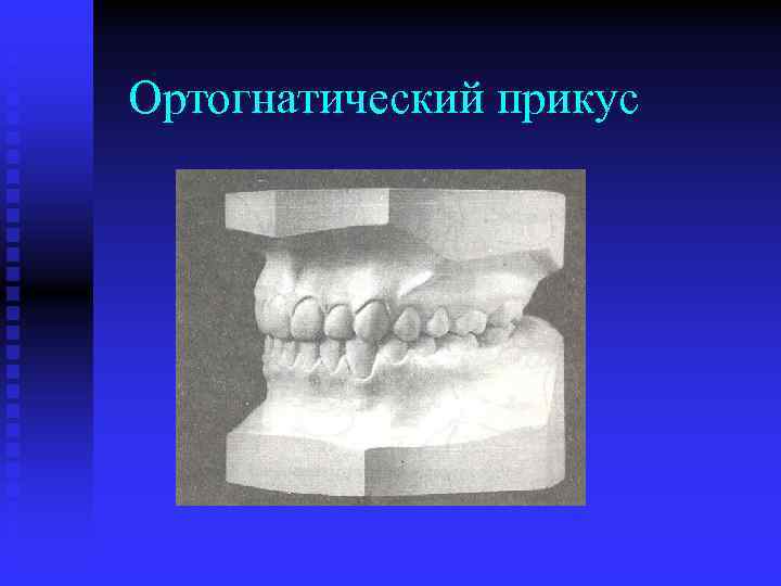 Ортогнатический прикус 