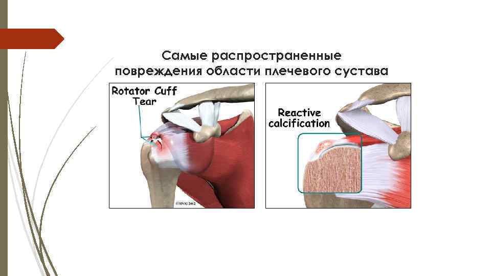 Повреждения плечевого пояса презентация