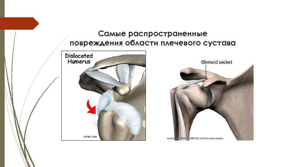 Самые распространенные повреждения области плечевого сустава 