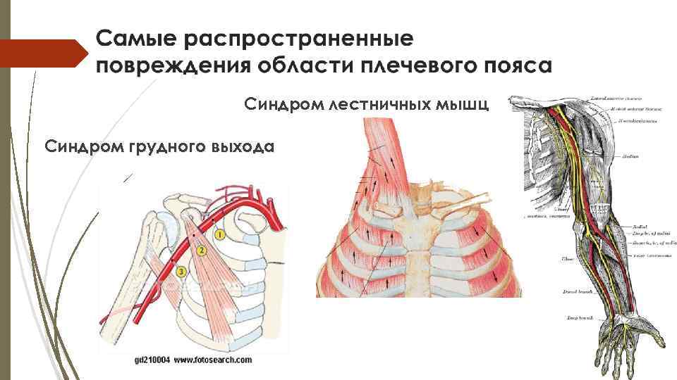 Синдром лестничных мышц Синдром грудного выхода 