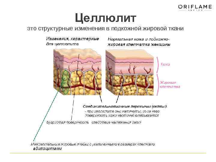 Целлюлит это структурные изменения в подкожной жировой ткани 