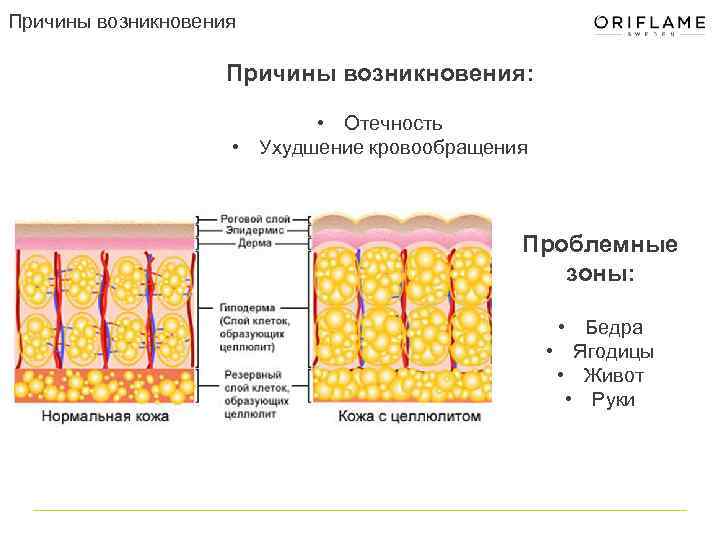 Причины возникновения: • Отечность • Ухудшение кровообращения Проблемные зоны: • Бедра • Ягодицы •