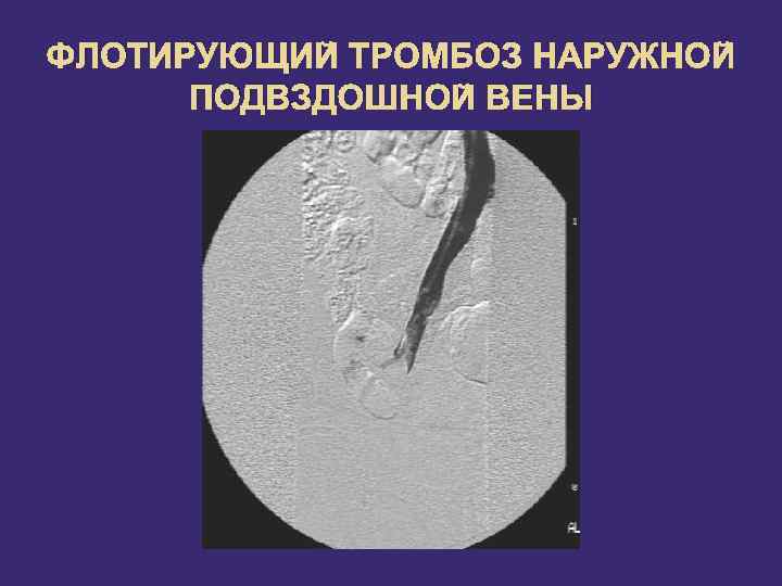 Острый тромбоз наружного геморроидального узла фото
