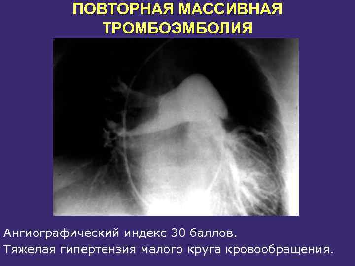 Острый тромбоз наружного геморроидального узла фото