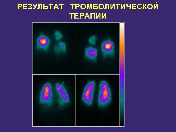 РЕЗУЛЬТАТ ТРОМБОЛИТИЧЕСКОЙ ТЕРАПИИ 