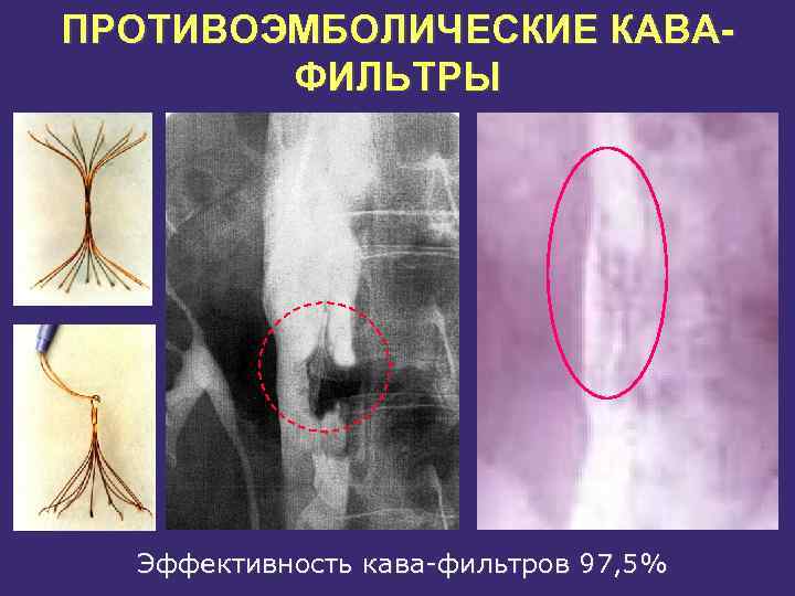 ПРОТИВОЭМБОЛИЧЕСКИЕ КАВАФИЛЬТРЫ Эффективность кава фильтров 97, 5% 