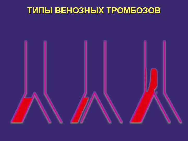 ТИПЫ ВЕНОЗНЫХ ТРОМБОЗОВ 