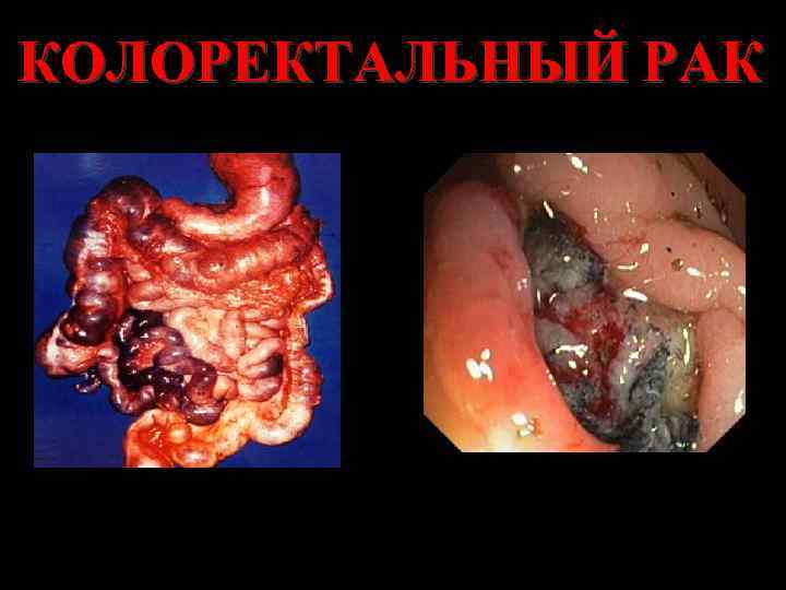 КОЛОРЕКТАЛЬНЫЙ РАК 