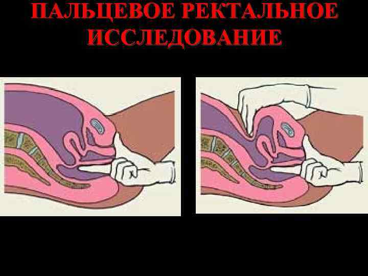 ПАЛЬЦЕВОЕ РЕКТАЛЬНОЕ ИССЛЕДОВАНИЕ 