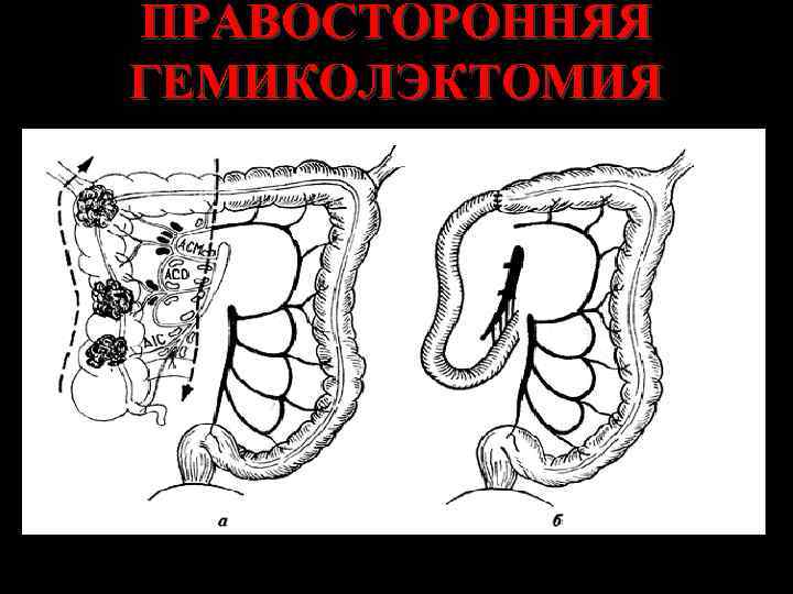 ПРАВОСТОРОННЯЯ ГЕМИКОЛЭКТОМИЯ 