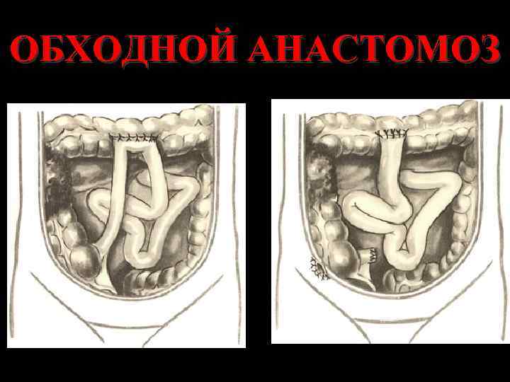 ОБХОДНОЙ АНАСТОМОЗ 