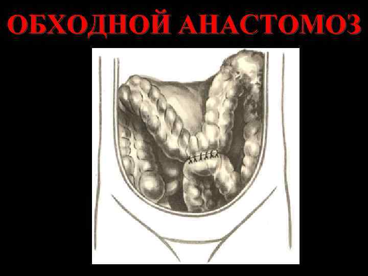 ОБХОДНОЙ АНАСТОМОЗ 
