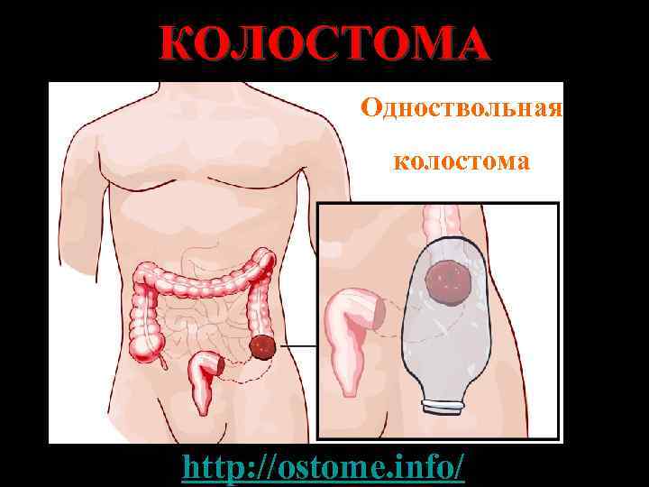 КОЛОСТОМА Одноствольная колостома http: //ostome. info/ 
