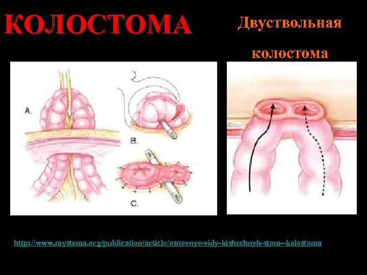 КОЛОСТОМА Двуствольная колостома http: //www. mystoma. org/publication/article/osnovnye-vidy-kishechnyh-stom--kolostoma 