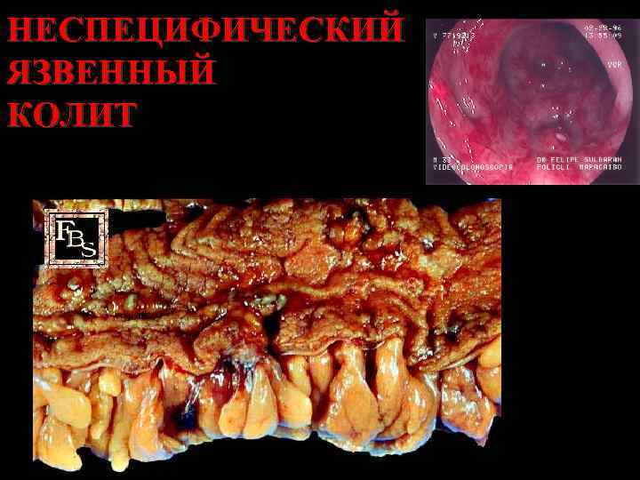 НЕСПЕЦИФИЧЕСКИЙ ЯЗВЕННЫЙ КОЛИТ 